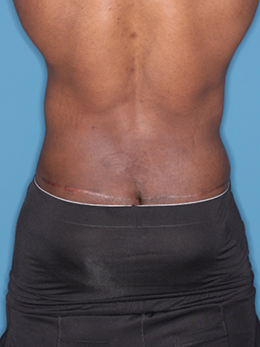 Case--36791 | After Body Lift for Men 6