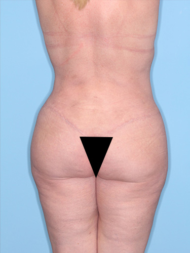Case--37163 | After Liposuction 6