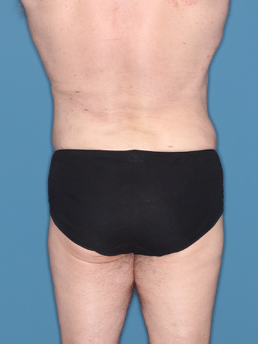 Case--36843 | After Liposuction for Men 6