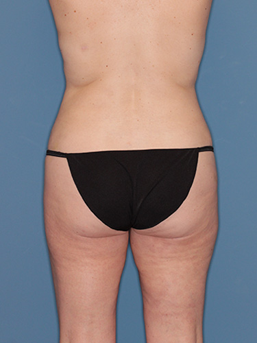 Case--40481 | After Liposuction 6