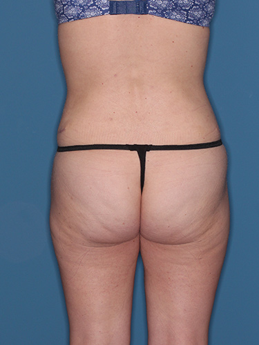 Case--38188 | After Liposuction 6