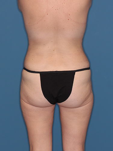 Case--38205 | After Breast Lift 6
