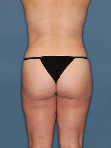 Case--43430 | After Breast Lift with Breast Reduction 6
