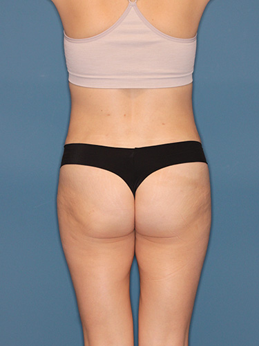 Case--40574 | After Liposuction 5