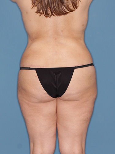 Case--39995 | After Lower Body Lift (Buttock Lift) 6