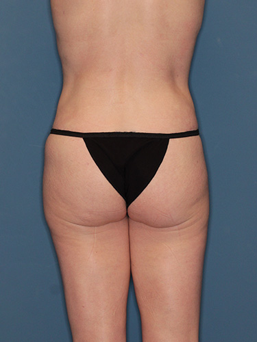 Case--42484 | After Fat Transfer to Buttocks 5