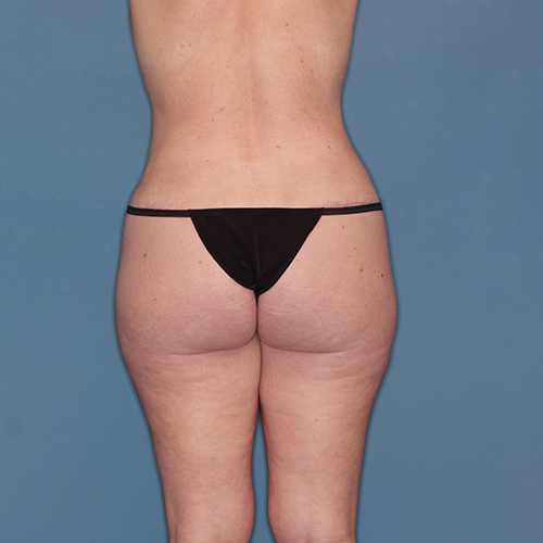 Case--45063 | After Fat Transfer to Buttocks 7