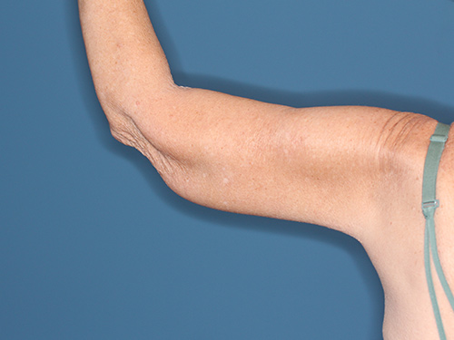 Case--37368 | After Arm Lift 4
