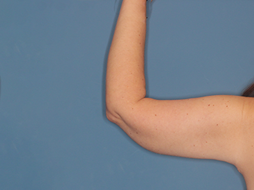 Case--43683 | After Arm Lift 3