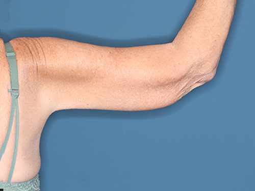 Case--37368 | After Arm Lift 3