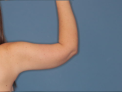 Case--43683 | After Arm Lift 4