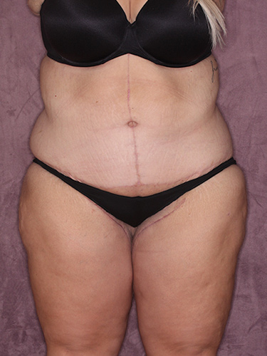 Case--39643 | After Thigh Lift 1