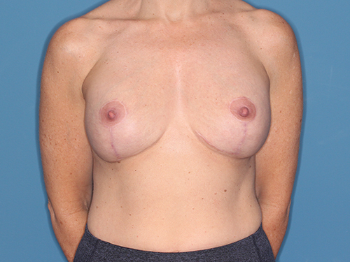 Case--38117 | After Corrective/Revision Breast Implant Surgery 1