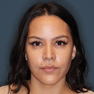 Case--42025 | After Facelift and Neck Lift 1