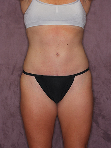 Case--39748 | After Liposuction 1