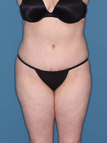 Case--37146 | After Liposuction 1