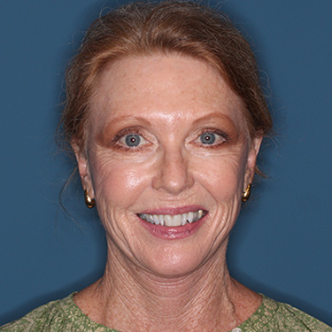 Case--36727 | After Facelift and Neck Lift 1