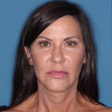 Case--37967 | After Facelift and Neck Lift 1