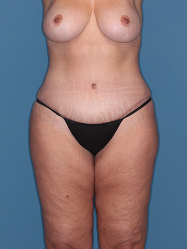 Case--39430 | After Fat Transfer to Buttocks 1