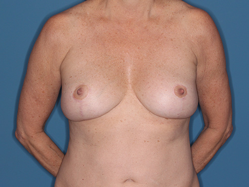 Case--37257 | After Breast Lift 1