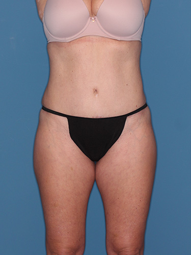 Case--39548 | After Liposuction 1