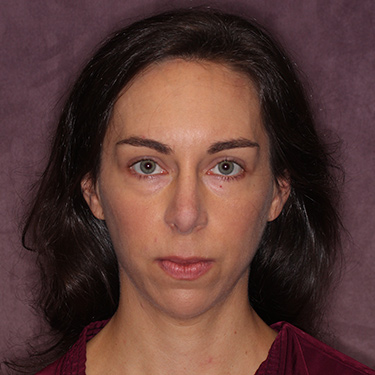 Case--36005 | After Nose Surgery (Rhinoplasty) 1