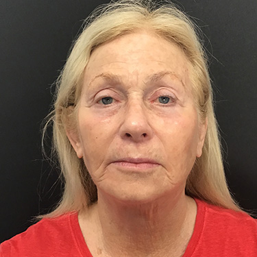 Case--39696 | After Eyelid Surgery (Blepharoplasty) 1