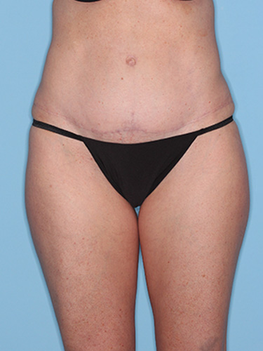Case--39580 | After Liposuction 1