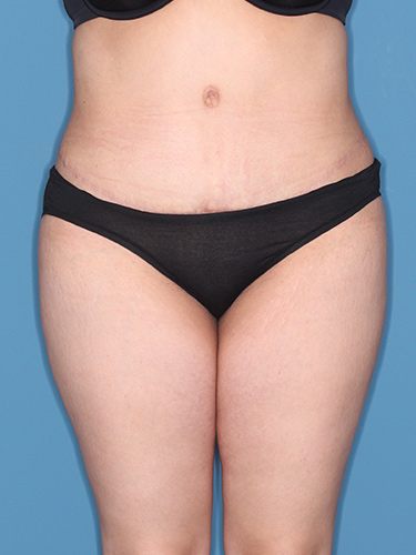 Case--37542 | After Liposuction 1