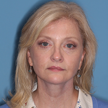 Case--36776 | After Brow Lift 1
