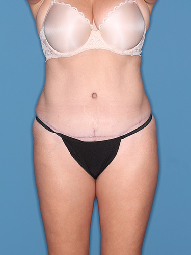 Case--37353 | After Fat Transfer to Buttocks 1
