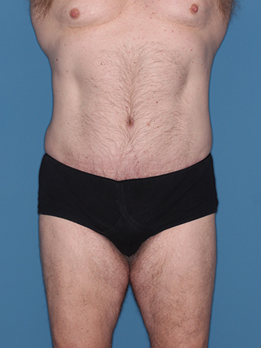Case--36843 | After Liposuction for Men 1