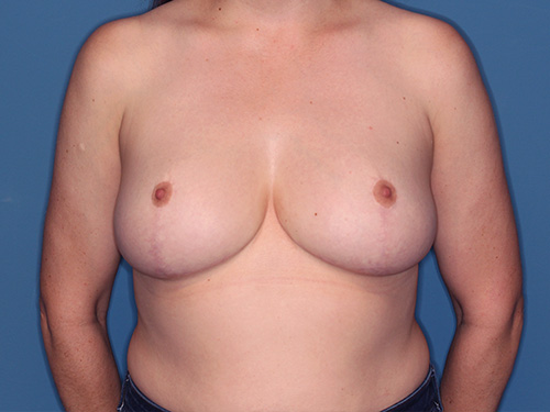 Case--40411 | After Breast Lift with Breast Reduction 1