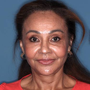 Case--38938 | After Eyelid Surgery (Blepharoplasty) 1
