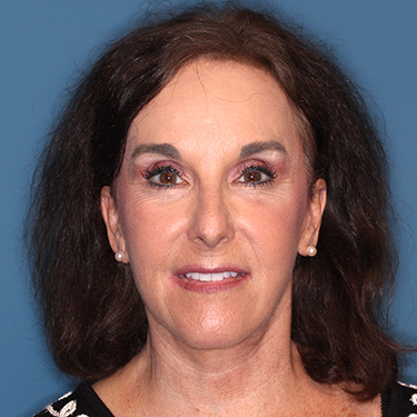 Case--38087 | After Brow Lift 1