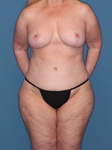 Case--40335 | After True Form Tummy Tuck® in Overweight & Weight Loss Patients 1