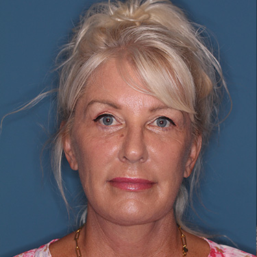 Case--40232 | After Facelift and Neck Lift 1