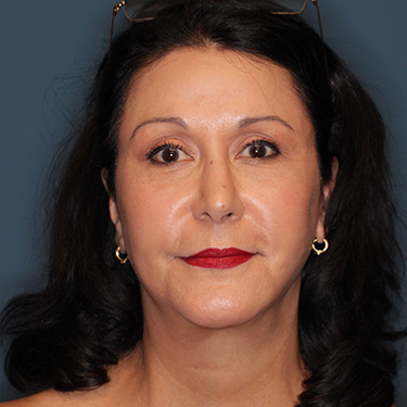 Case--40089 | After Eyelid Surgery (Blepharoplasty) 1