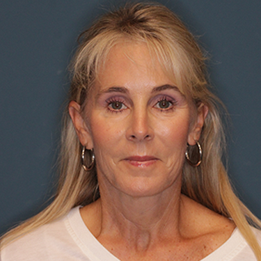 Case--837079 | After Brow Lift 1