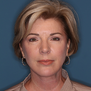 Case--38239 | After Eyelid Surgery (Blepharoplasty) 1