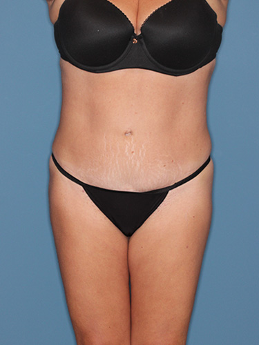 Case--39166 | After True Form Tummy Tuck® 1