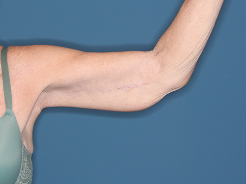 Case--37368 | After Arm Lift 2