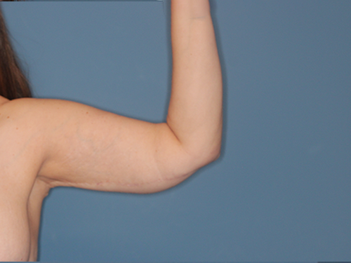 Case--43683 | After Arm Lift 2