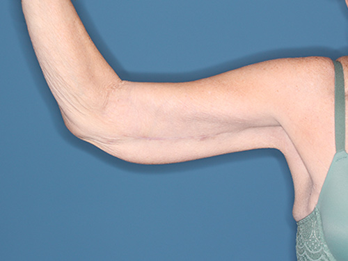 Case--37368 | After Arm Lift 1