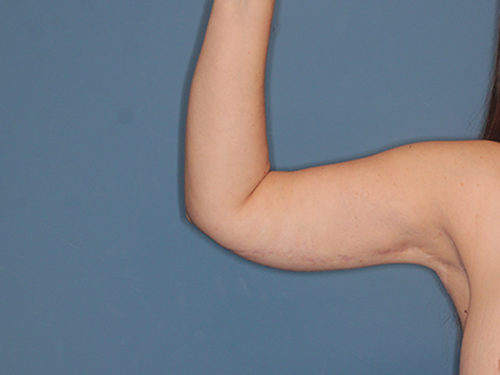 Case--43683 | After Arm Lift 1