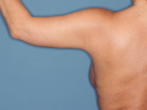 Case--40562 | After Arm Lift 4