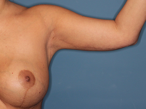 Case--40562 | After Arm Lift 2