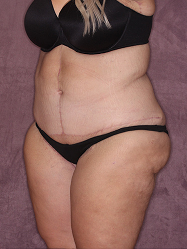 Case--39643 | After Thigh Lift 3
