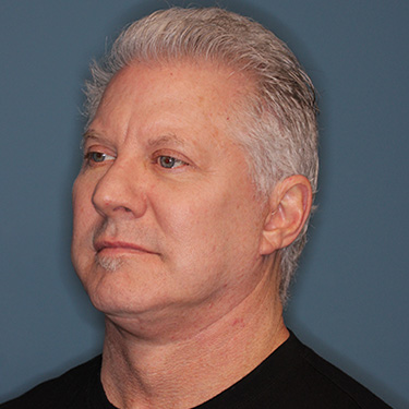 Case--40290 | After Facelift and Neck Lift for Men 3