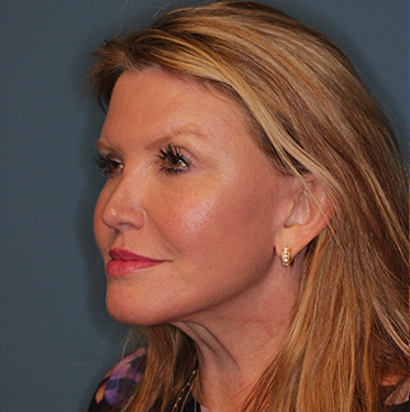 Case--41496 | After Eyelid Surgery (Blepharoplasty) 3